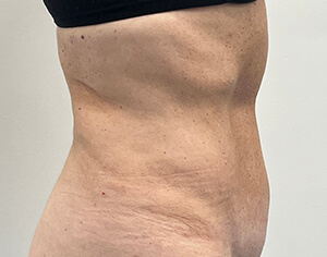 Tummy Tuck Side After